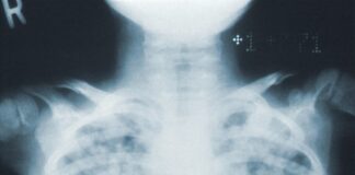 Tuberculose mata 4 mil brasileiros por ano; conheça a doença e os sintomas