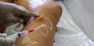 A cada dia, 145 mulheres são internadas para tratar varizes