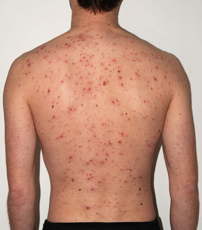 Catapora: Uma Infecção Com Riscos Mais Graves em Adultos saude