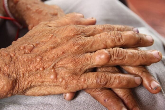 Neurofibromatose: Condição Genética Rara que Afeta a Pele e o Sistema Neurológico saude