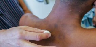 Campanha Janeiro Roxo alerta para importância do diagnóstico precoce de hanseníase