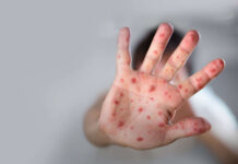 Surtos de sarampo triplicam em três anos e ameaçam reverter décadas de progresso, alerta OMS