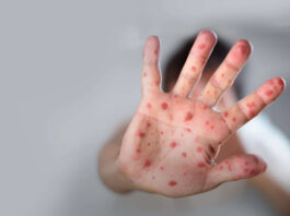 Surtos de sarampo triplicam em três anos e ameaçam reverter décadas de progresso, alerta OMS