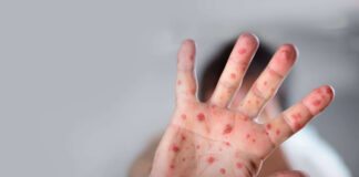 Brasil volta a ser certificado como país livre do sarampo pela Opas