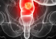 Câncer colorretal avança no Brasil e maioria dos casos é diagnosticada tardiamente