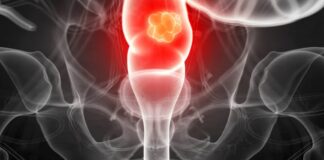 Câncer colorretal avança no Brasil e maioria dos casos é diagnosticada tardiamente