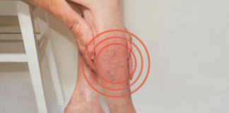 Síndrome rara pode causar complicações graves, alerta Sociedade de Angiologia