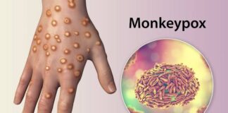 Brasil confirma primeiro caso da cepa 1b da mpox