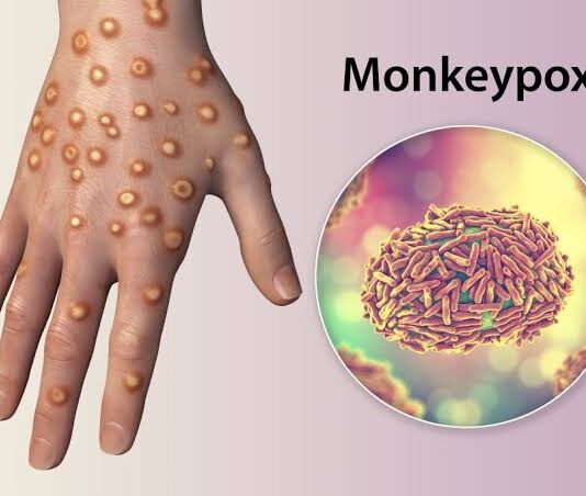 Brasil confirma 88 casos de Mpox; São Paulo concentra maioria dos registros