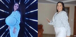 Jovem paranaense retira 10 kg das mamas em cirurgia após condição rara