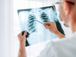Anvisa aprova novo medicamento para câncer de pulmão avançado