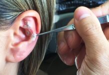 Senac-DF ensina Auriculoterapia